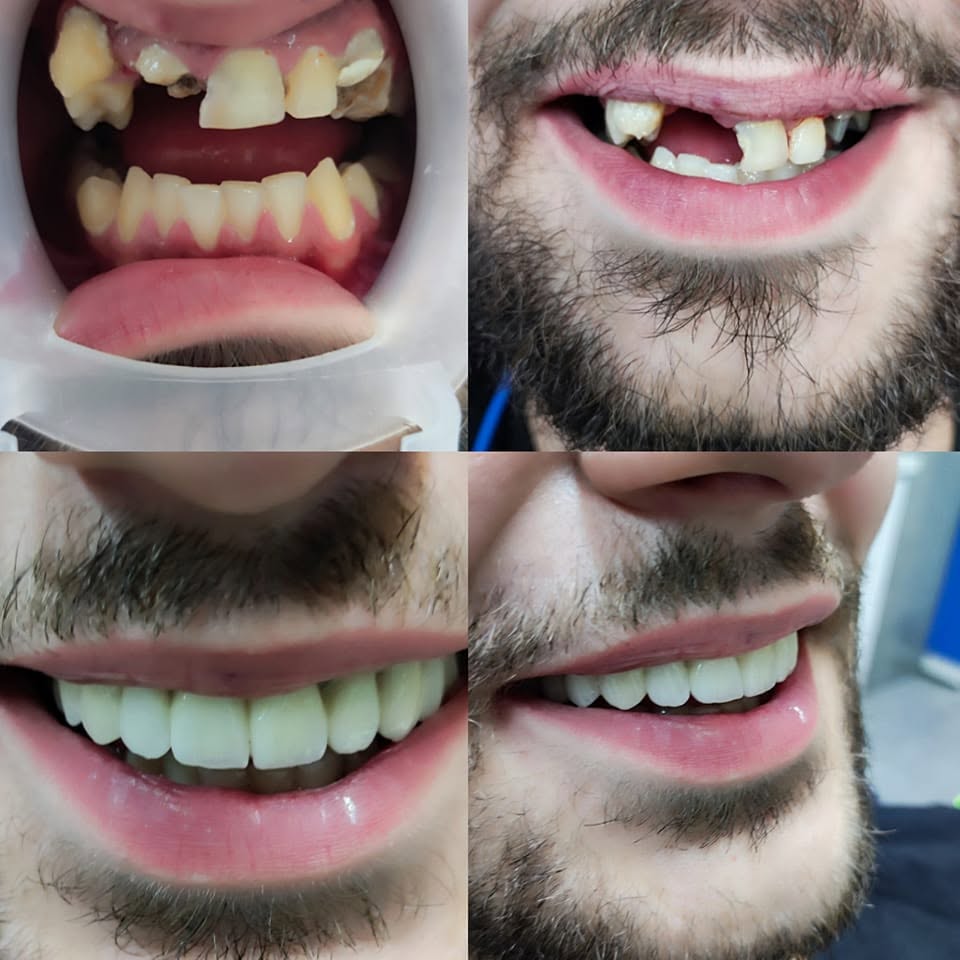 Koraci transformacije osmijeha pacijenta